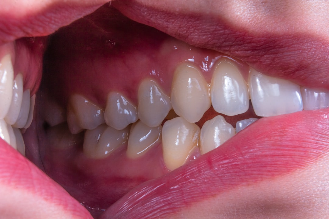 mouth Ulcers