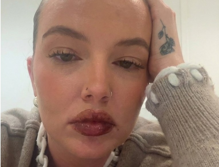 She Spent $500 on a Trendy Lip Treatment and the Results Were Absolutely Horrifying