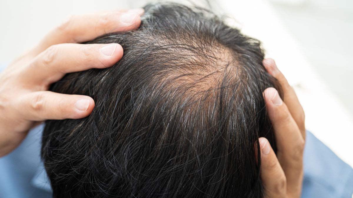 Man Started Losing His Hair Then Shaved His Head and People Say He Looks Eight Years Younger