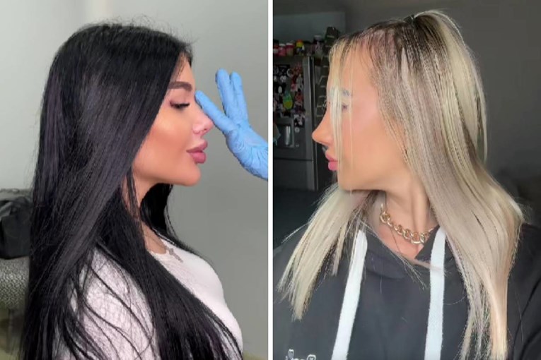 The Barbie Nose Trend Gains Popularity as Doctors Raise Concerns: “There’s No Going Back”