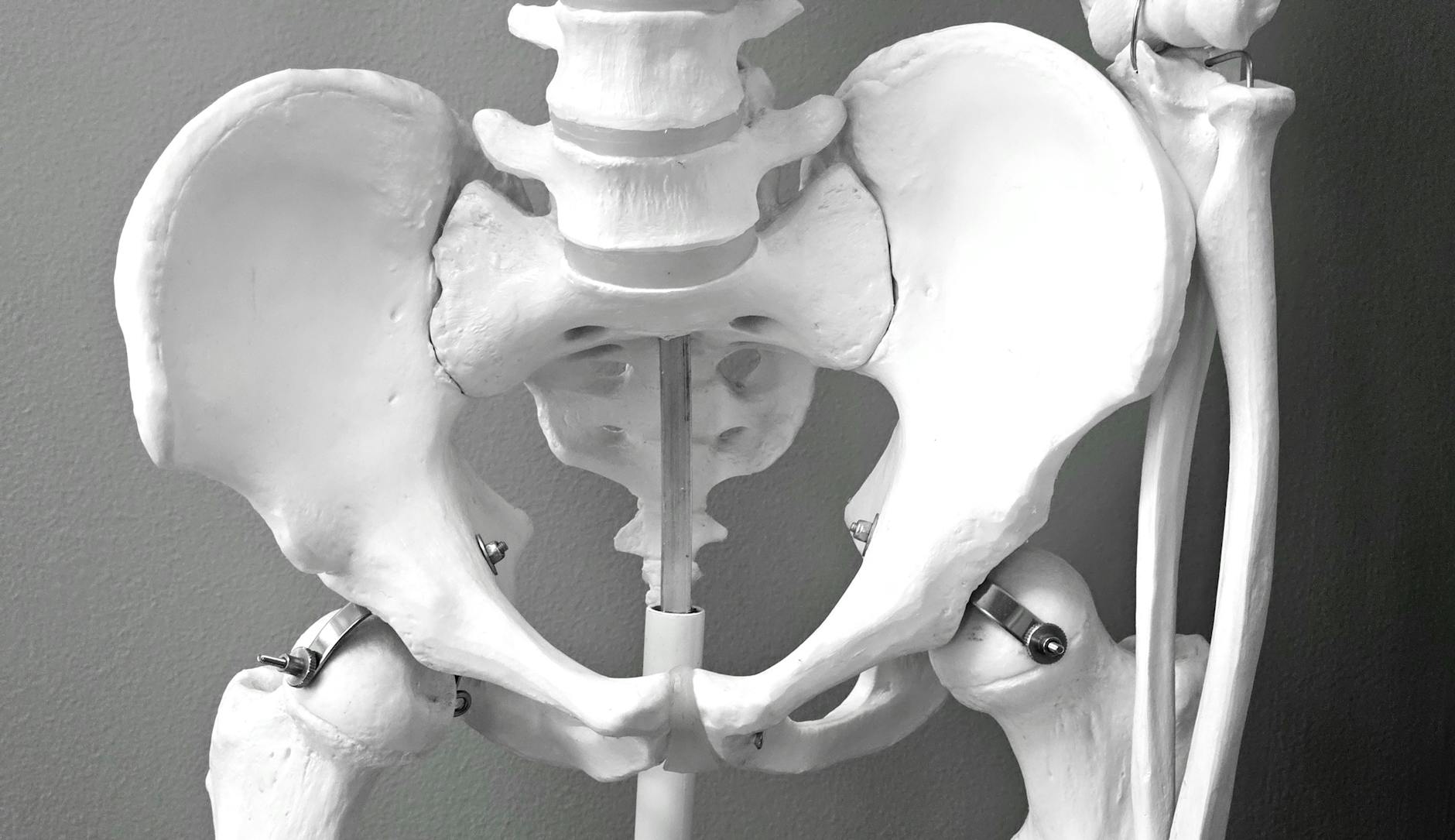 Misaligned Pelvis Illustration