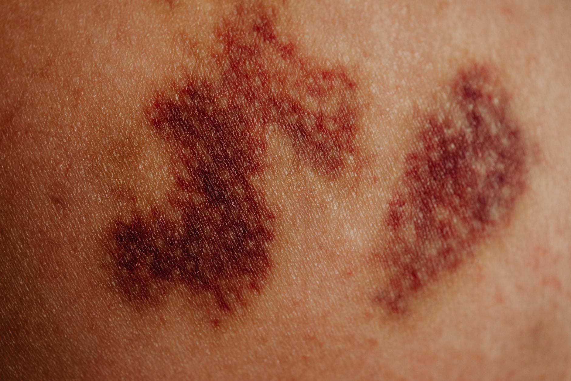 Visible Capillaries Skin