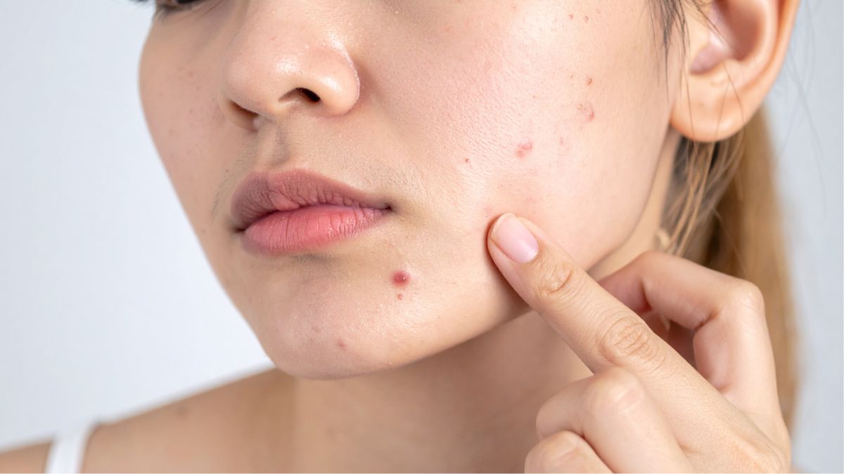 Surprising Reasons Why Your Skin Keeps Breaking Out No Matter How Much You Spend