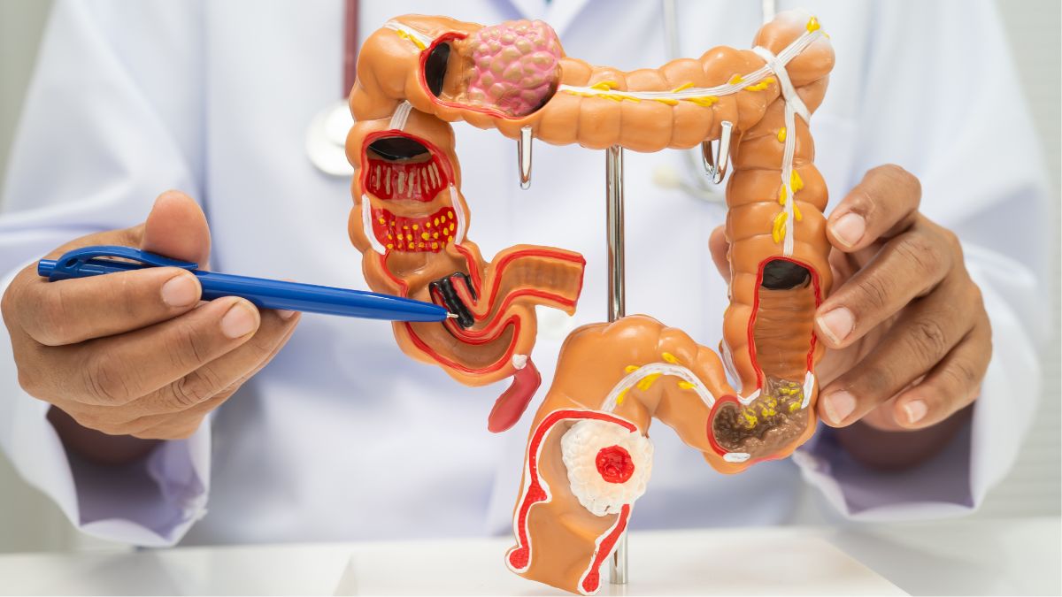 5 Types of Cancer Are Rapidly Rising Worldwide and Here Is How to Reduce Your Risk