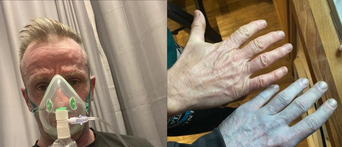 Man Wakes Up Blue and Is Rushed to Hospital as Doctors Soon Discover the Bizarre Reason
