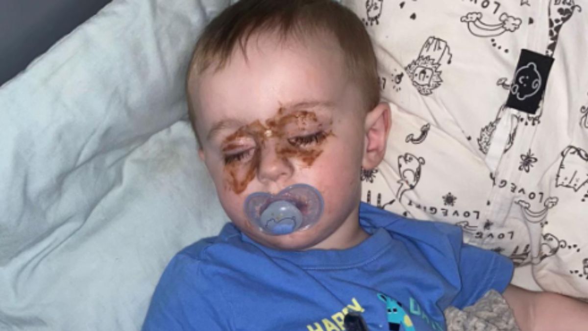 A Mom Noticed Strange Marks Around Her Son’s Eyes and Then Realized What Had Happened