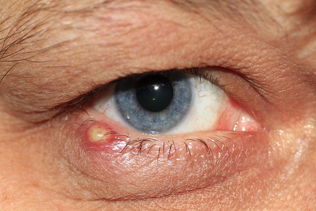 Eye Inflammation Signs