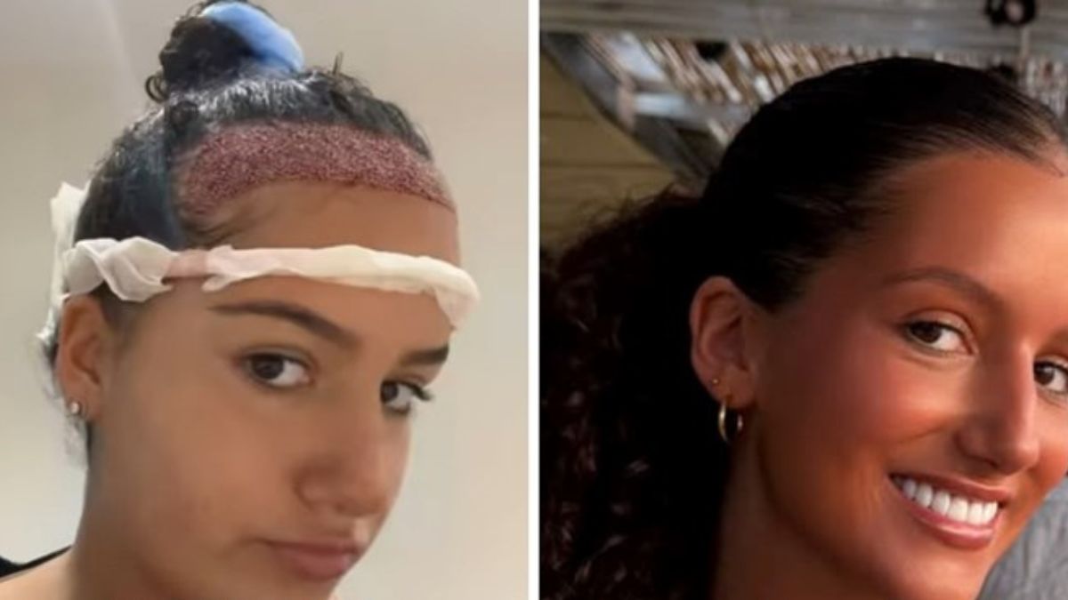Teenager Flew to Turkey for Hair Transplant After Years of Insecurity