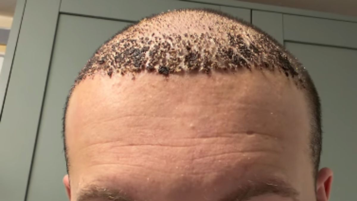 A Barber Shared the Real Recovery After His Hair Transplant and Ouch.