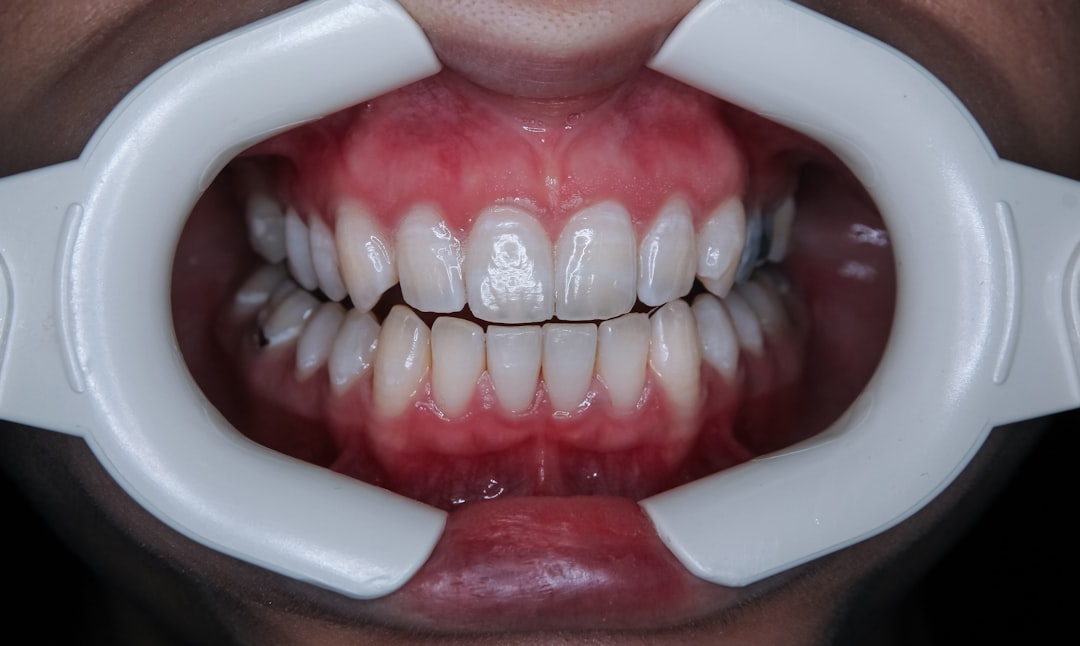 Dry Socket Teeth