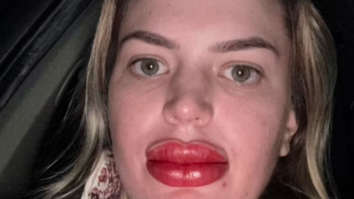 TikToker Ends Up With Massive Lip Swelling After Trying Popular Lip Blushing Treatment