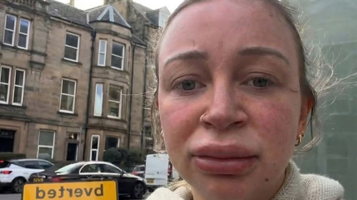 A Mom Had Her Lip Fillers Dissolved and Left the Internet in Stitches: “This Is How I Showed Up to Pick My Kid Up From Daycare”