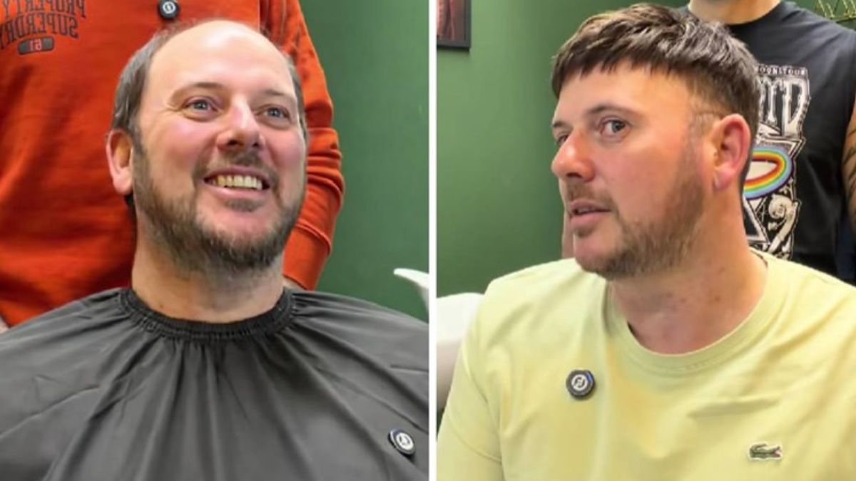He Looked in the Mirror After a Hair Replacement Treatment and Burst Into Tears: “I’ve Been Bald for 20 Years”