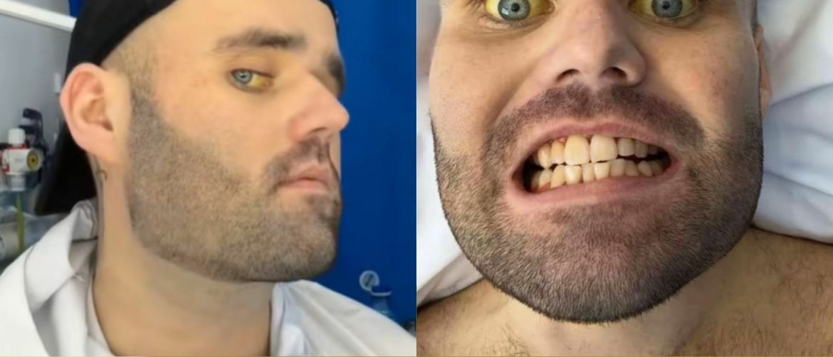 Drank Six Bottles of Wine a Day and Shares the Terrifying Toll It Took on His Health