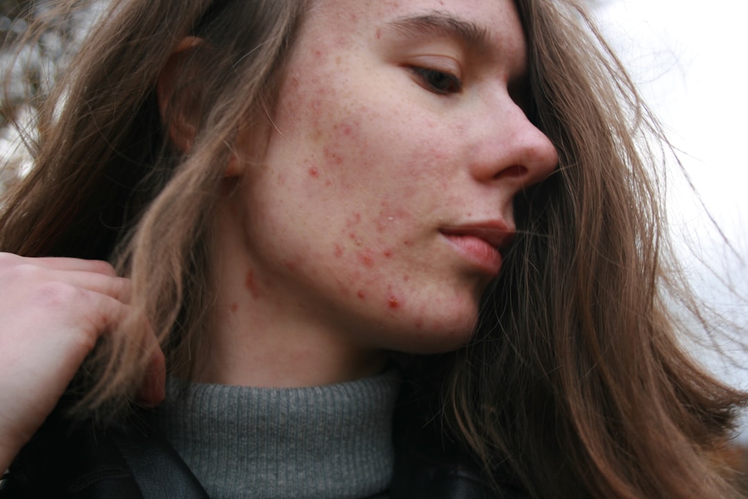 Dirty Skin Acne