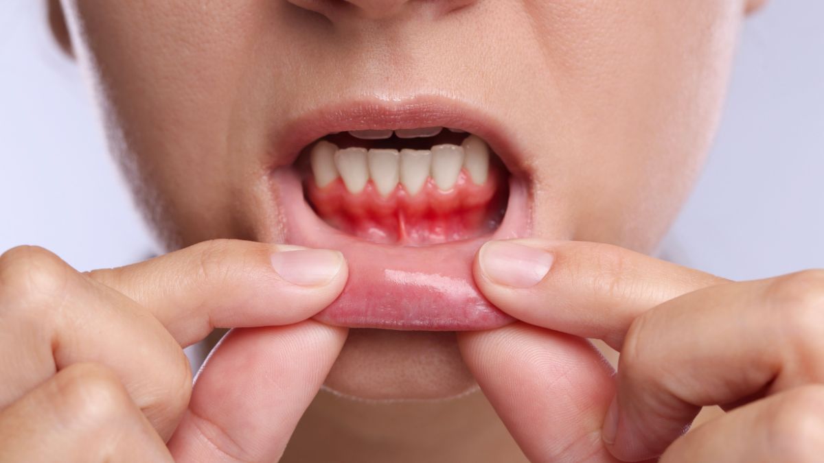Why Your Bleeding Gums Could Be a Warning Sign of a Crucial Vitamin Deficiency